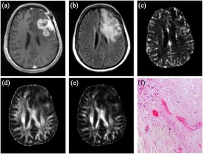 Commentary: Pitfalls in the Neuroimaging of Glioblastoma in the Era of Antiangiogenic and Immuno/Targeted Therapy